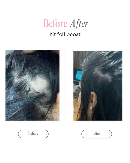 Tónico estimulador de crecimiento y regulador de sebo (bergamora romero y minoxidil 5%)
