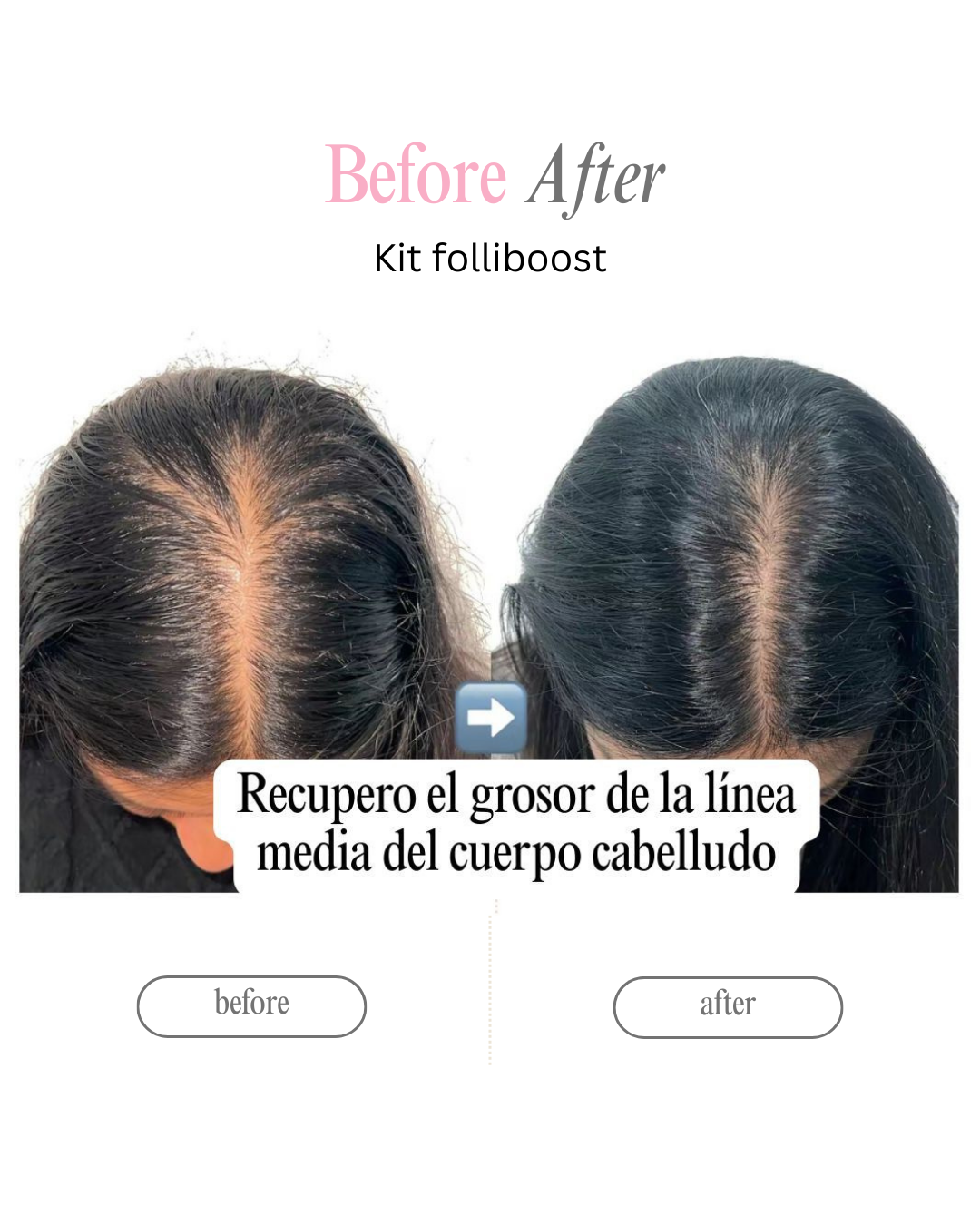 Kit Folliboost “Impulso Máximo de crecimiento”🍃