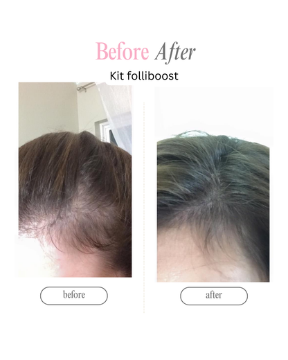 Tónico estimulador de crecimiento y regulador de sebo (bergamora romero y minoxidil 5%)