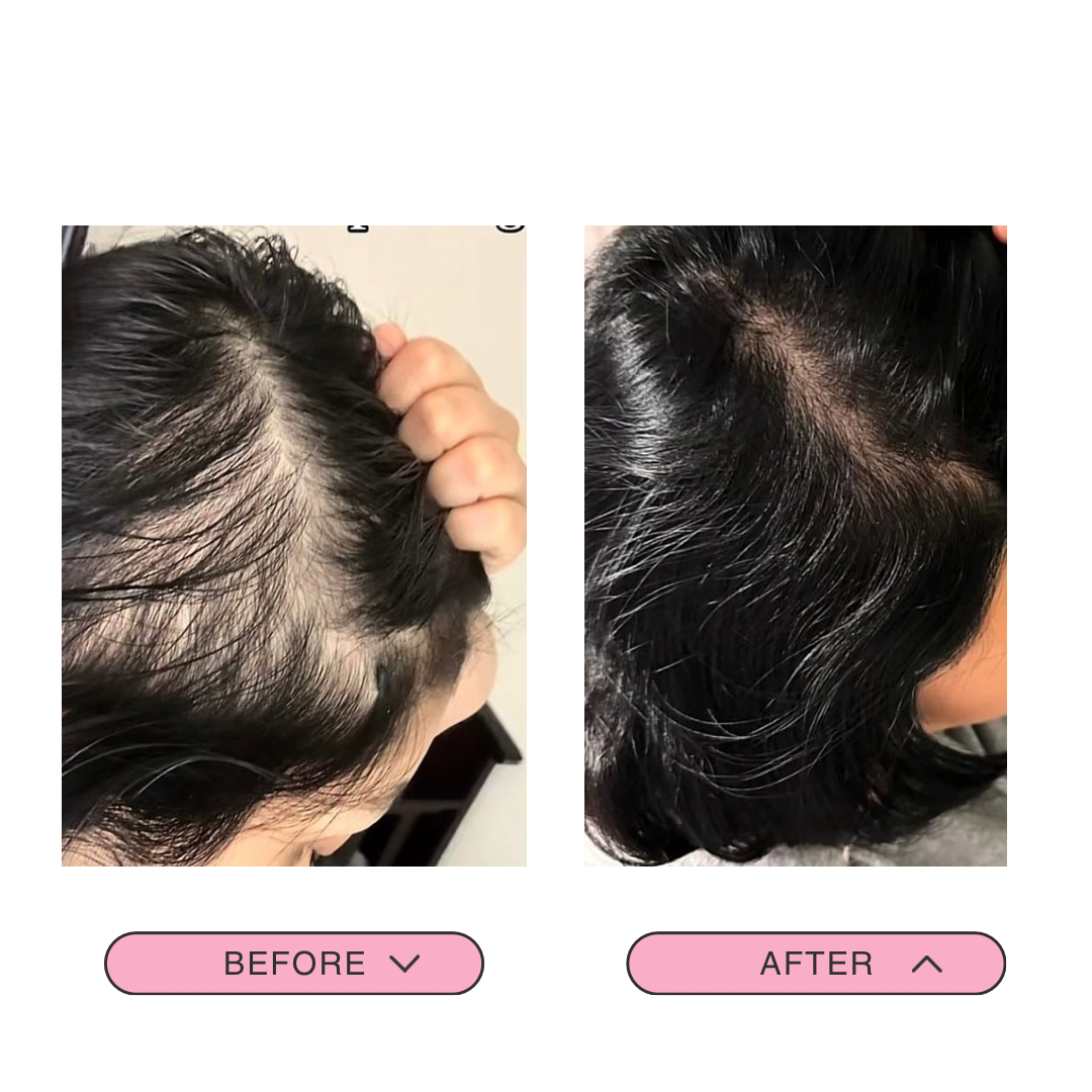 Tónico capilar estimulador de crecimiento y regulador de sebo (bergamora romero y minoxidil 5%)